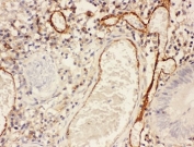 IHC staining of FFPE human intestinal cancer with ICAM-1 antibody at 1ug/ml. HIER: boil tissue sections in pH6, 10mM citrate buffer, for 10-20 min and allow to cool before testing.