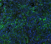 Immunofluorescent staining of FFPE human lung cancer with ICAM-1 antibody (green) at 1ug/ml and DAPI nuclear counterstain (blue). HIER: boil tissue sections in pH6, 10mM citrate buffer, for 10-20 min and allow to cool before testing.