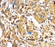 IHC-P: Bid antibody testing of human breast cancer tissue