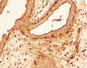 IHC-P: Cofilin antibody testing of human breast cancer tissue. HIER: steam section in pH6 citrate buffer for 20 min.