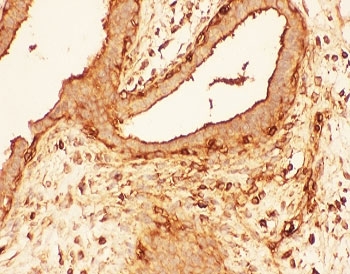 IHC-P: Cofilin antibody testing of human breast cancer tissue. HIER: steam section in pH6 citrate buffer for 20 min.