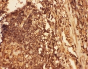 IHC-P: Cofilin antibody testing of human intestine cancer tissue. HIER: steam section in pH6 citrate buffer for 20 min.