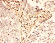 IHC-P: LIF antibody testing of human lung cancer tissue