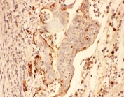 IHC-P: MMP7 antibody testing of human intestine cancer tissue