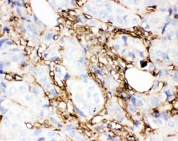 IHC-P: Annexin V antibody testing of human breast cancer tissue