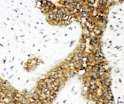 IHC-P: Calbindin antibody testing of human breast cancer tissue. HIER: steam section in pH6 citrate buffer for 20 min and allow to cool prior to staining.