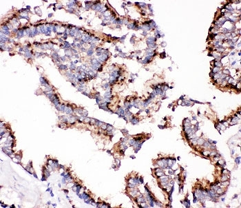 IHC-P: Cathepsin D antibody testing of human lung cancer tissue