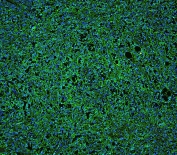 Immunofluorescent staining of FFPE human B lymphocytic tumor tissue with CD20 antibody (green) at 1ug/ml and DAPI nuclear stain (blue). HIER: boil tissue sections in pH6, 10mM citrate buffer, for 10-20 min and allow to cool before testing.