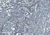 IHC staining of FFPE human ovarian cancer with CD34 antibody. HIER: boil tissue sections in pH8 EDTA for 20 min and allow to cool before testing.