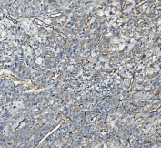 IHC staining of FFPE human liver cancer with CD34 antibody. HIER: boil tissue sections in pH8 EDTA for 20 min and allow to cool before testing.