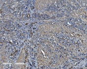 IHC staining of FFPE human gastric cancer with CD34 antibody. HIER: boil tissue sections in pH8 EDTA for 20 min and allow to cool before testing.