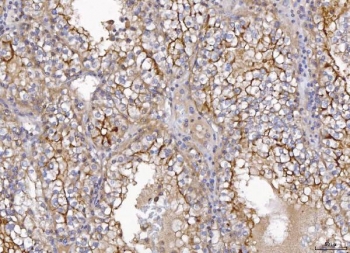 IHC staining of FFPE human renal cell carcinoma tissue with CD10 antibody. HIER: boil tissue sections in pH8 EDTA for 20 min and allow to cool before testing.