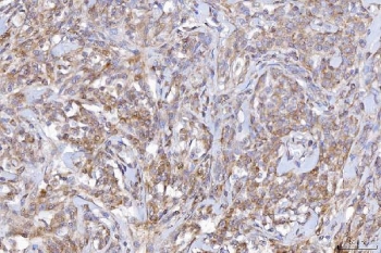 IHC staining of FFPE human lymphoma tissue with CD10 antibody. HIER: boil tissue sections in pH8 EDTA for 20 min and allow to cool before testing.