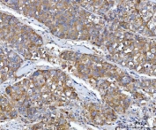 IHC staining of FFPE human liver cancer tissue with Src antibody. HIER: boil tissue sections in pH8 EDTA for 20 min and allow to cool before testing.