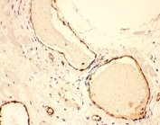 IHC-P: VWF antibody testing of human lung cancer tissue. HIER: steam section in pH6 citrate buffer for 20 min and allow to cool prior to testing.