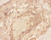 IHC-P: Eotaxin 3 antibody testing of human breast cancer tissue