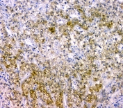 IHC staining of FFPE human liver cancer with p27KIP1 antibody at 1ug/ml. HIER: boil tissue sections in pH6, 10mM citrate buffer, for 10-20 min and allow to cool before testing.