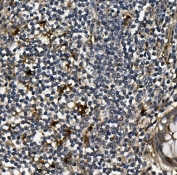 IHC staining of FFPE human rectal cancer with VEGF antibody. HIER: boil tissue sections in pH6, 10mM citrate buffer, for 20 min and allow to cool before testing.