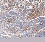 IHC staining of FFPE human ovarian serous adenocarcinoma tissue with VEGF antibody. HIER: boil tissue sections in pH8 EDTA for 20 min and allow to cool before testing.