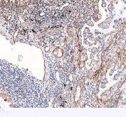 IHC staining of FFPE human lung cancer tissue with VEGF antibody. HIER: boil tissue sections in pH8 EDTA for 20 min and allow to cool before testing.