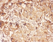 IHC-P: ALOX15 antibody testing of human breast cancer tissue
