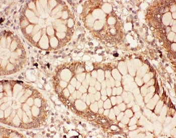 IHC-P: ALOX15 antibody testing of human intestine cancer tissue