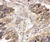 IHC staining of FFPE human intestinal cancer with CBL antibody. HIER: boil tissue sections in pH6, 10mM citrate buffer, for 20 min and allow to cool before testing.