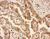 IHC-P: CXCR3 antibody testing of human lung cancer tissue