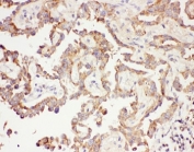 IHC-P: Galectin 3 antibody testing of human lung cancer tissue. HIER: steam section in pH6 citrate buffer for 20 min.