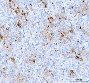 IHC staining of FFPE human glioma tissue with GFAP antibody. HIER: boil tissue sections in pH8 EDTA for 20 min and allow to cool before testing.