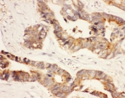 IHC-P: HSP90 alpha antibody testing of human intestinal cancer tissue. HIER: steamed with pH6 citrate buffer.