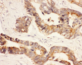 IHC-P: HSP90 antibody testing of human intestinal cancer tissue. HIER: steamed with pH6 citrate buffer.