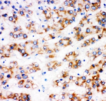IHC staining of FFPE human liver cancer tissue with AFP antibody. HIER: boil tissue sections in pH6 citrate buffer for 20 min and allow to cool before testing.~