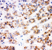 IHC staining of FFPE human liver cancer tissue with AFP antibody. HIER: boil tissue sections in pH6 citrate buffer for 20 min and allow to cool before testing.