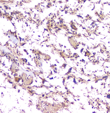 IHC staining of FFPE human glioma tissue with Amyloid beta antibody at 1ug/ml. HIER: boil tissue sections in pH6, 10mM citrate buffer, for 10-20 min and allow to cool before testing.