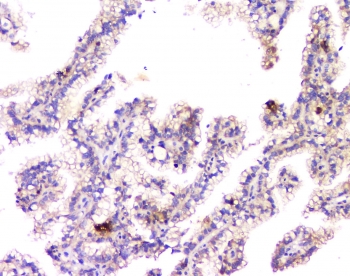IHC staining of FFPE human renal cancer with Amyloid beta antibody at 1ug/ml. HIER: boil tissue sections in pH6, 10mM citrate buffer, for 10-20 min and allow to cool before testing.