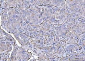 IHC staining of FFPE human hepatocellular carcinoma tissue with CD31 antibody. HIER: boil tissue sections in pH8 EDTA for 20 min and allow to cool before testing.