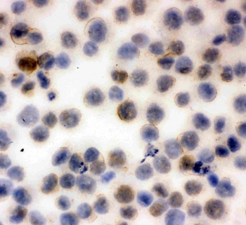 ICC staining of FFPE human K562 cells with CD43 antibody. HIER: boil tissue sections in pH6, 10mM citrate buffer, for 10-20 min and allow to cool before testing.