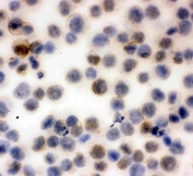 Immunocytochemical staining of FFPE human K562 cells with CD43 antibody. HIER: boil tissue sections in pH6, 10mM citrate buffer, for 10-20 min and allow to cool before testing.