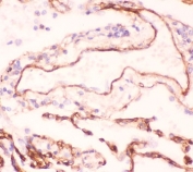 IHC-P: Collagen IV antibody testing of human lung cancer tissue. HIER: boil tissue sections in pH6, 10mM citrate buffer, for 10-20 min and allow to cool before testing.