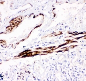 IHC staining of FFPE human lung cancer tissue with Desmin antibody. HIER: boil tissue sections in pH8 EDTA for 20 min and allow to cool before testing.