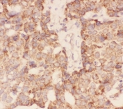 IHC-P: FSH beta antibody testing of human breast cancer tissue