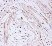 IHC-P: GLUT4 antibody testing of human intestinal cancer tissue