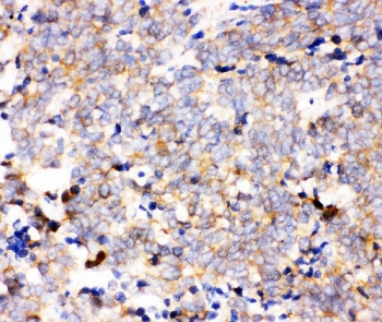 IHC staining of FFPE human lung cancer tissue with IKK alpha antibody. HIER: boil tissue sections in pH8 EDTA for 20 min and allow to cool before testing.~