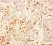 IHC-P: Kv2.1 antibody testing of human lung cancer tissue