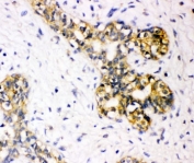 IHC-P: TSC2 antibody testing of human breast cancer tissue