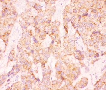 IHC-P: AAMP antibody testing of human breast cancer tissue