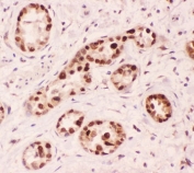 IHC-P: APE1 antibody testing of human lung cancer tissue. HIER: steam section in pH6 citrate buffer for 20 min.