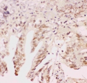 IHC staining of FFPE human intestinal cancer tissue with ATF1 antibody. HIER: boil tissue sections in pH6 citrate buffer for 20 min and allow to cool before testing.