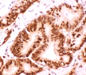 IHC testing of FFPE human intestinal cancer tissue with ATF2 antibody at 1ug/ml. Required HIER: steam section in pH6 citrate buffer for 20 min and allow to cool prior to staining.